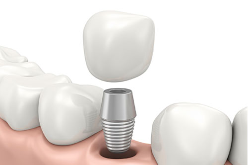 dental implants