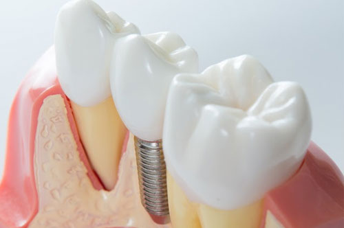 dental implant