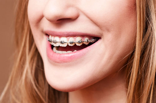 ortho classic braces