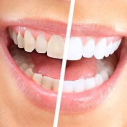 Teeth whitening before and after