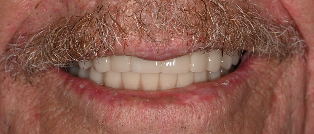 After All on X with The Village Dental Miami in Pinecrest-Dav