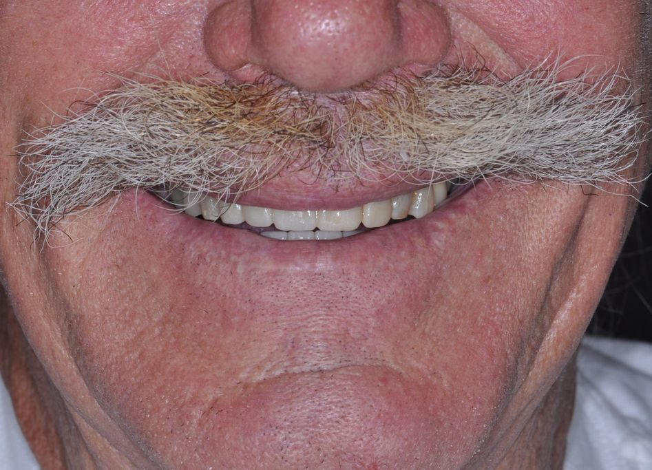 After Anterior Bridge with The Village Dental Miami-BR