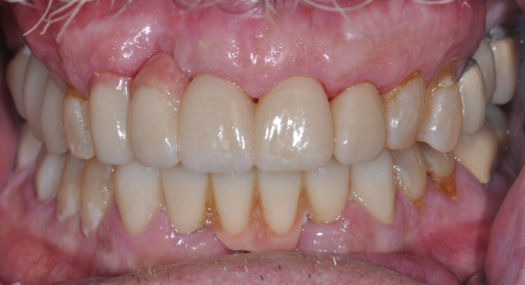 After Anterior Bridge with The Village Dental Miami in Pinecrest FL