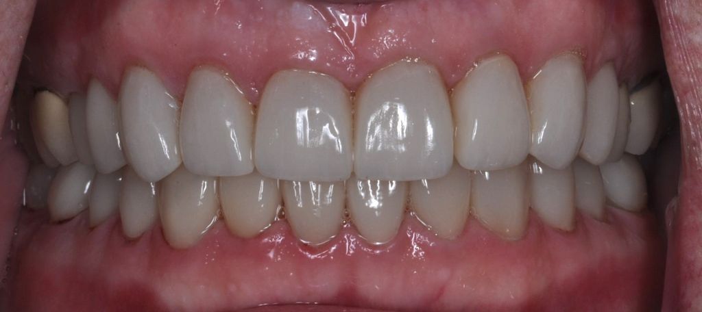 After Cosmetic Veneers with The Village Dental Miami in Pinecrest-MD