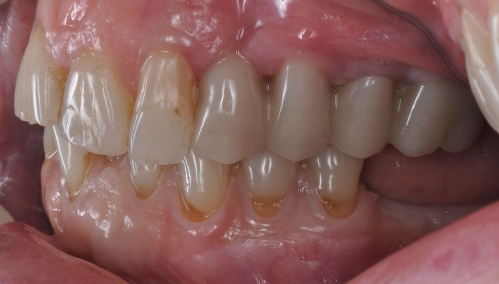 After Dental Bridges with The Village Dental Miami in Pinecrest FL-Pat01