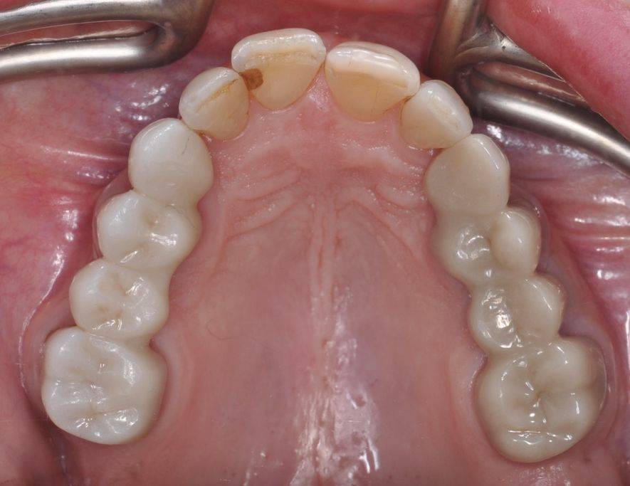 After Dental Bridges with The Village Dental Miami in Pinecrest FL-Pat03