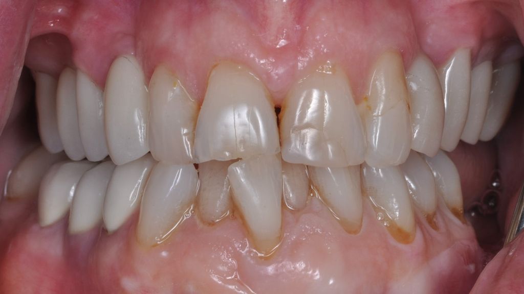 After Dental Bridges with The Village Dental Miami in Pinecrest-Pat