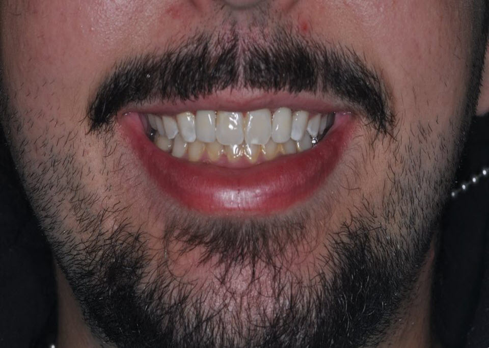 After Dental Implants with The Village Dental Miami FL- MA