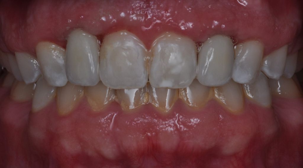 After Dental Implants with The Village Dental Miami Team