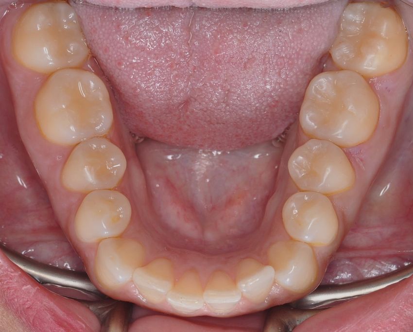 After Dental Resins with The Village Dental Miami in Pinecrest FL-Steph01