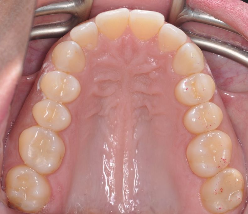 After Dental Resins with The Village Dental Miami in Pinecrest FL-Steph02