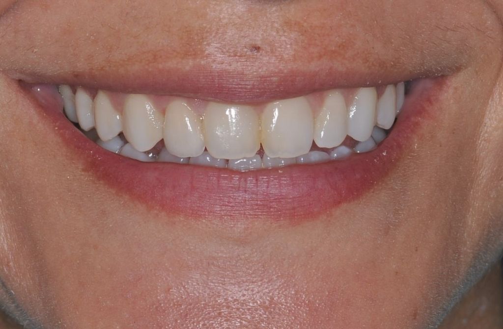 After Single Anterior Veneer with The Village Dental Miami in Pinecrest-Tif