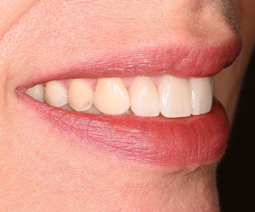 After anterior cosmetic veneers with The Village Dental in Pinecrest FL-K2