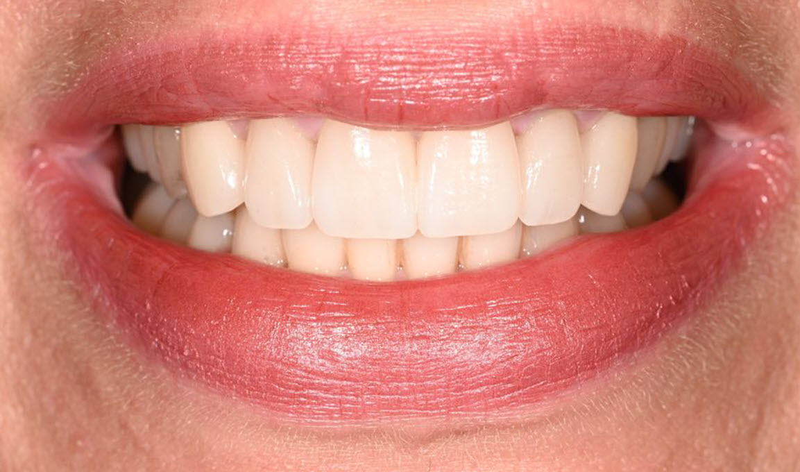 After anterior cosmetic veneers with The Village Dental in Pinecrest FL-K