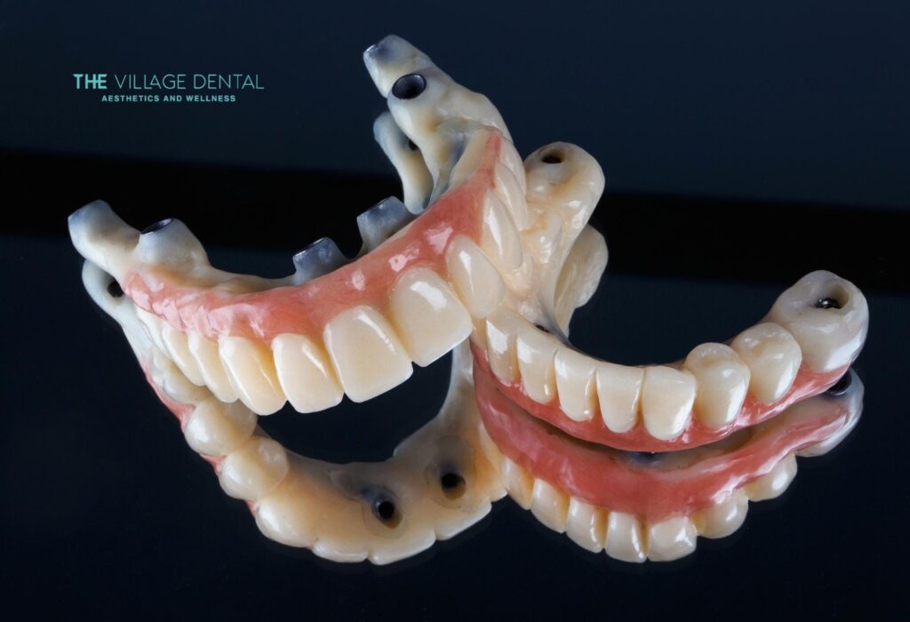 All-on-4 full mouth restoration dental prosthetics displayed, showcasing advanced cosmetic dentistry solutions by The Village Dental in Pinecrest, FL, designed for patients missing most or all teeth.