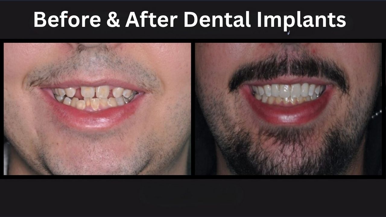 Before and after comparison of a man's smile transformation through dental implants, showcasing improved aesthetics and restored confidence, emphasizing The Village Dental's expertise in Pinecrest, FL.
