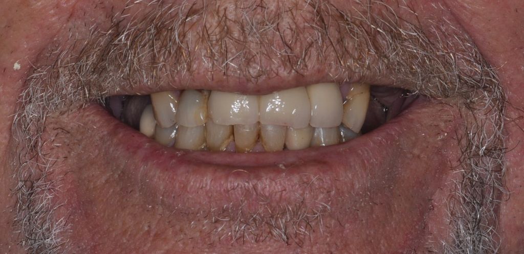 Before All on X with The Village Dental Miami in Pinecrest-Dav