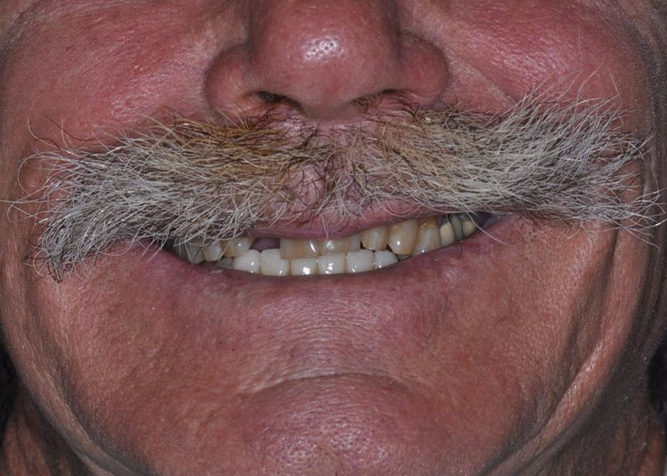 Before Anterior Bridge with The Village Dental Miami-BR