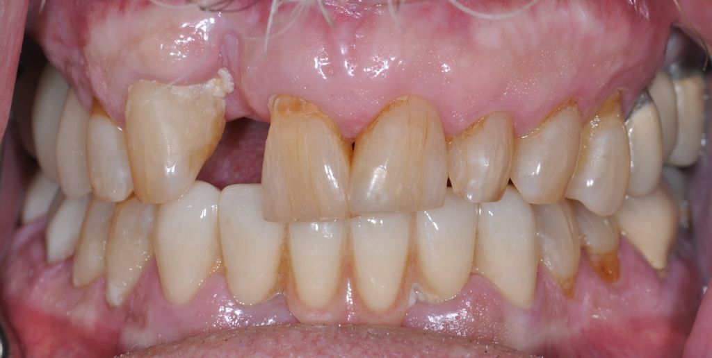 Before Anterior Bridge with The Village Dental Miami in Pinecrest FL-BR