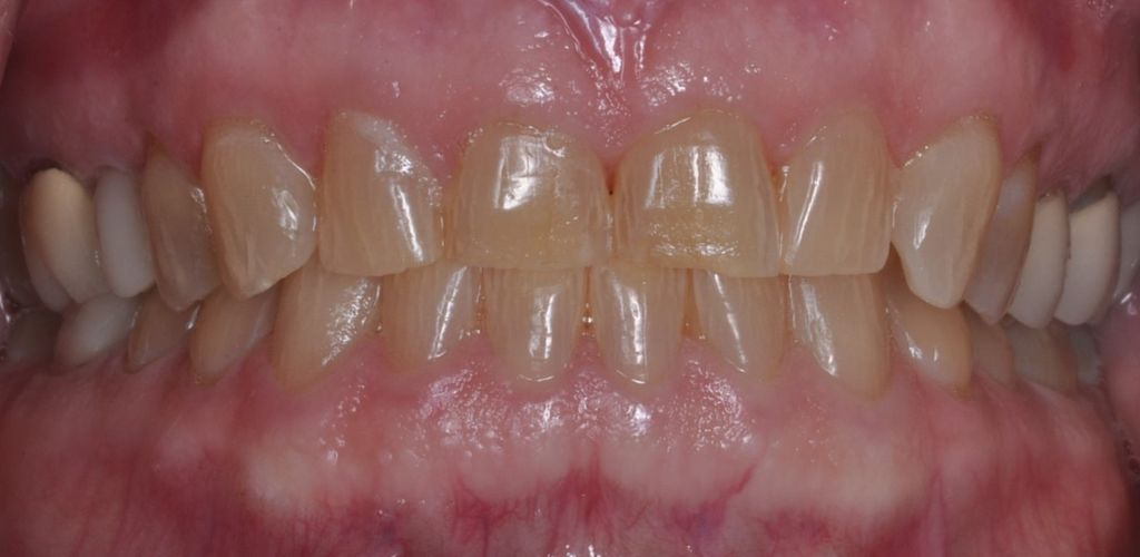 Before Cosmetic Veneers with The Village Dental Miami in Pinecrest-MD