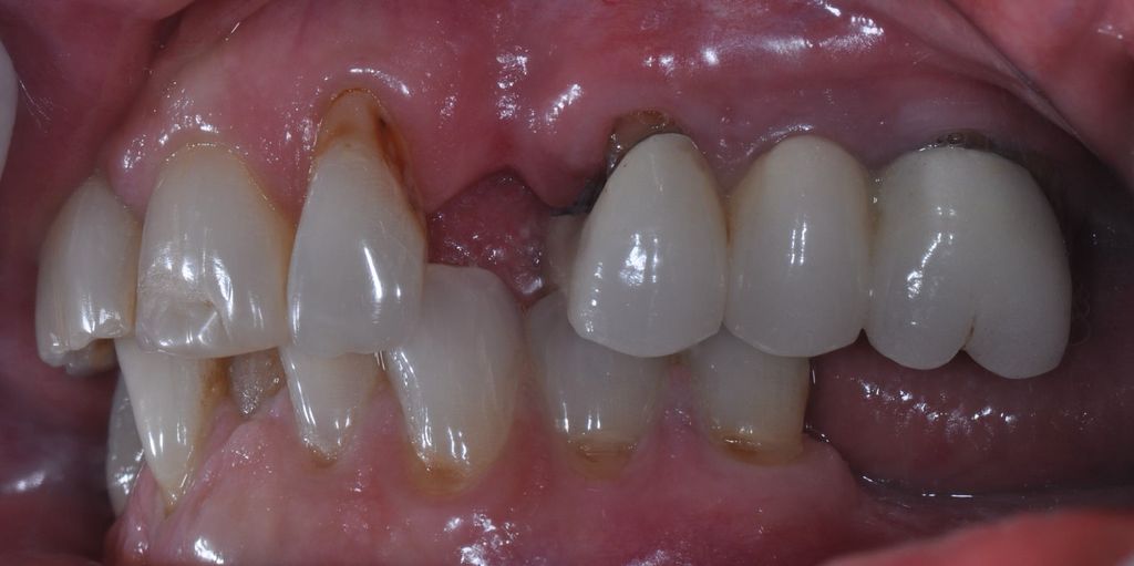 Before Dental Bridges with The Village Dental Miami in Pinecrest FL-Pat01