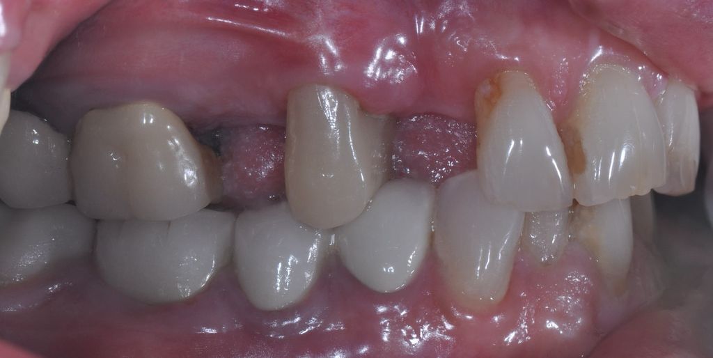 Before Dental Bridges with The Village Dental Miami in Pinecrest FL-Pat02