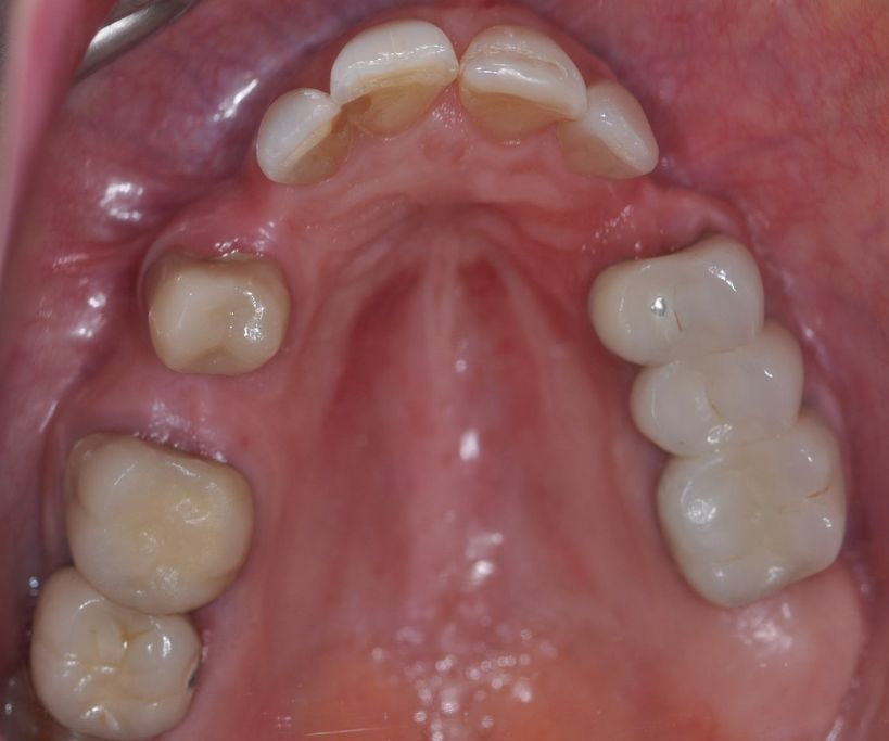 Before Dental Bridges with The Village Dental Miami in Pinecrest FL-Pat03