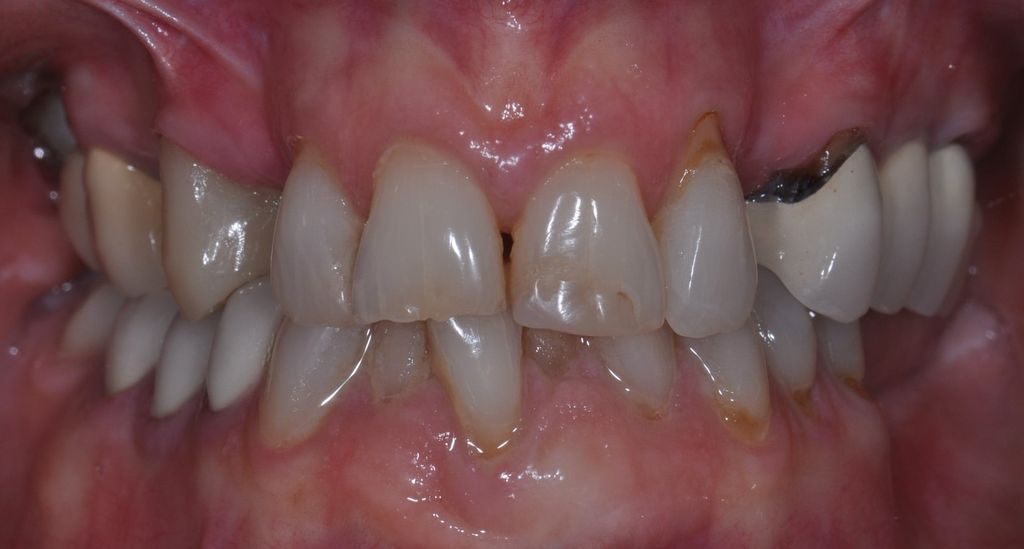 Before Dental Bridges with The Village Dental Miami in Pinecrest-Pat