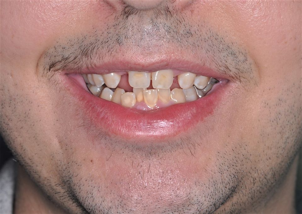 Before Dental Implants with The Village Dental Miami FL- MA.jpg