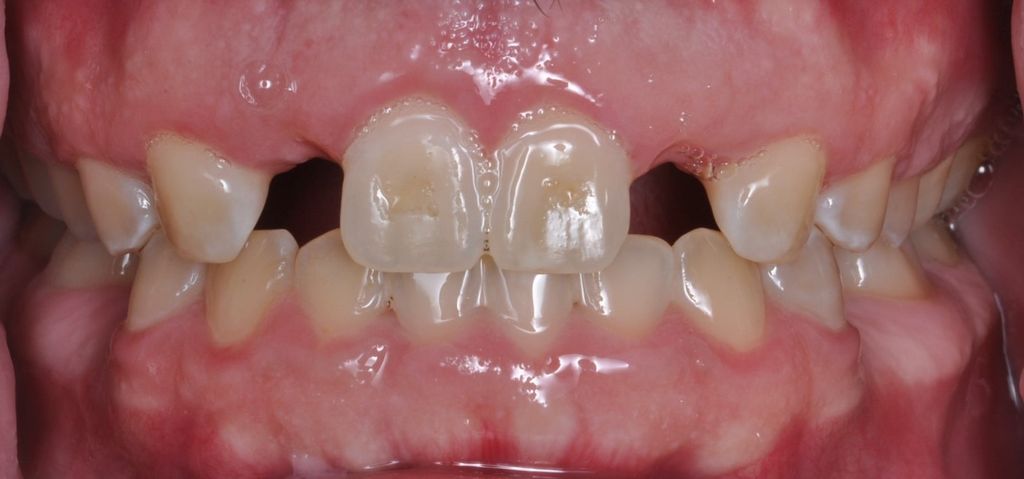 Before Dental Implants with The Village Dental Miami Team