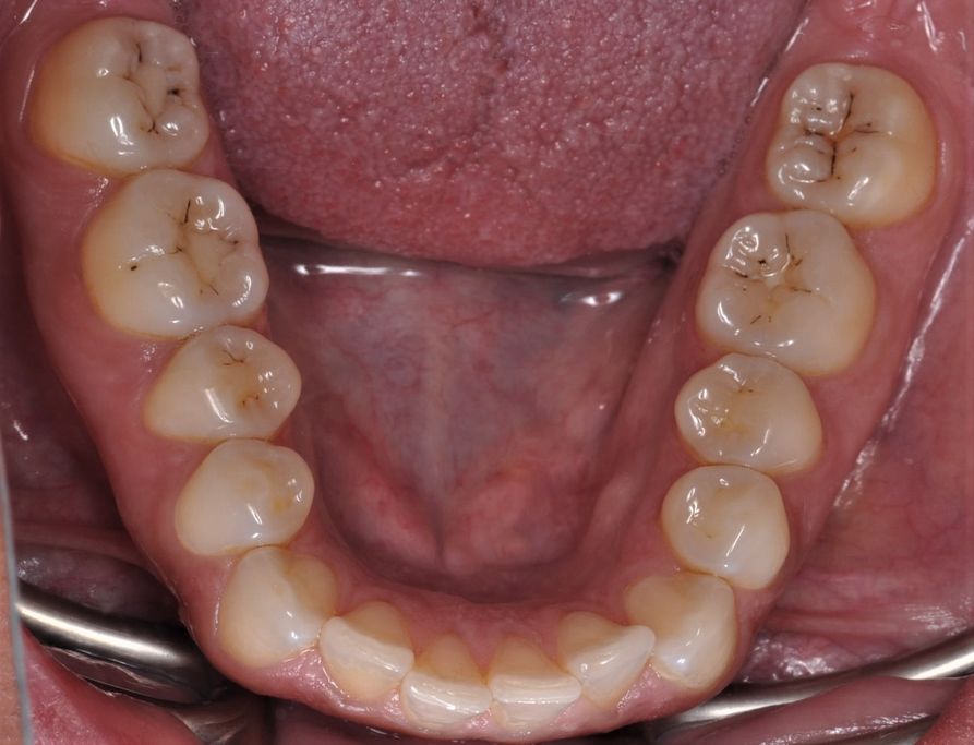 Before Dental Resins with The Village Dental Miami in Pinecrest FL-Steph01