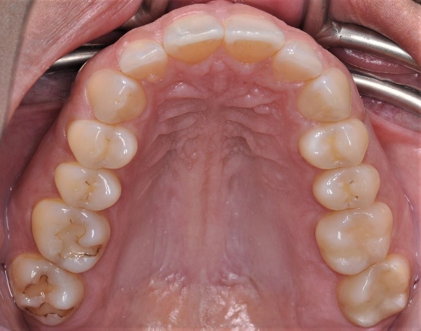 Before Dental Resins with The Village Dental Miami in Pinecrest FL-Steph02