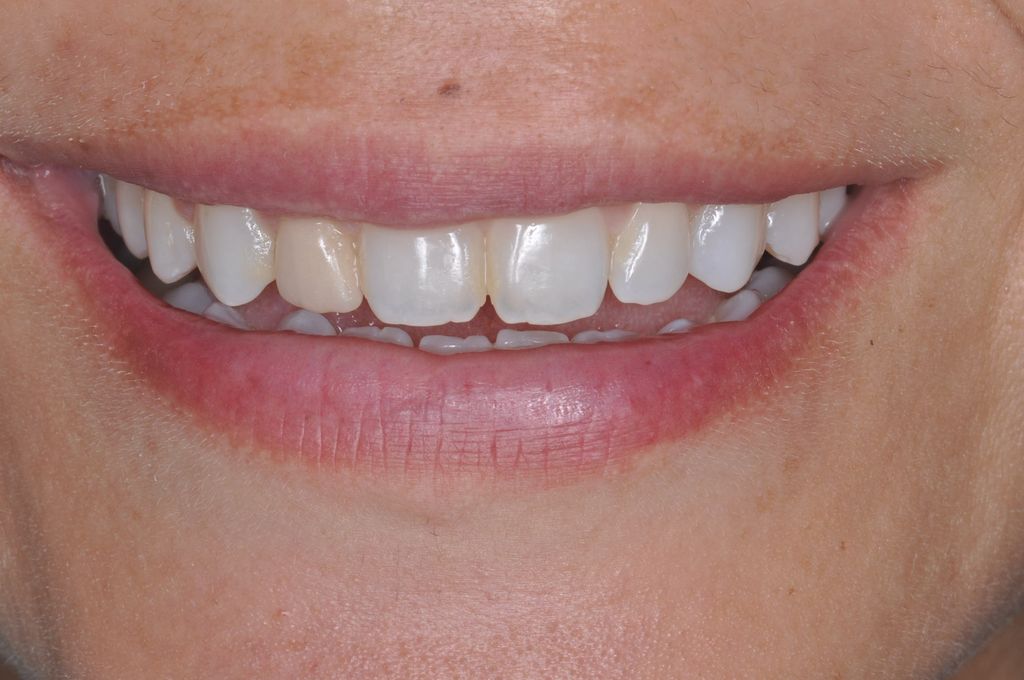 Before Single Anterior Veneer with The Village Dental Miami in Pinecrest-Tif