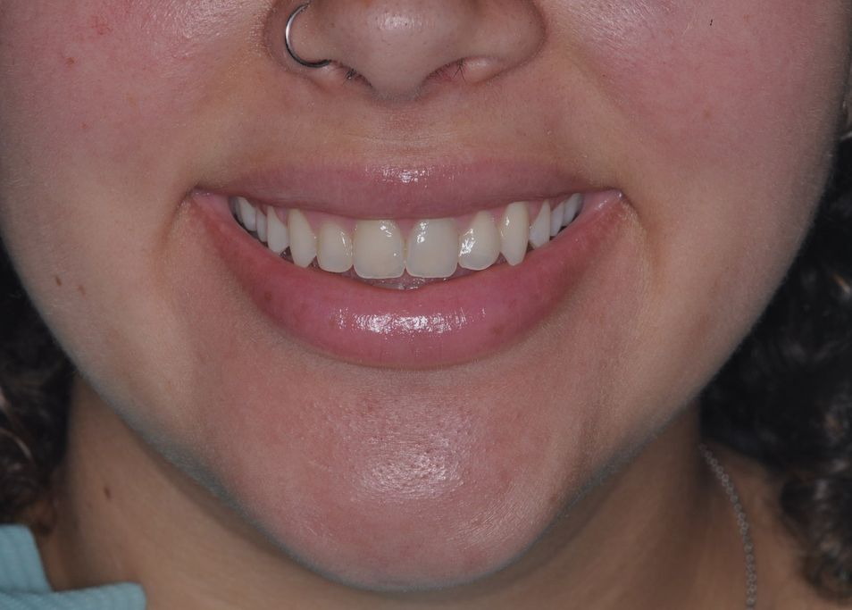 Before Veneers with The Village Dental Miami in Pinecrest-GG
