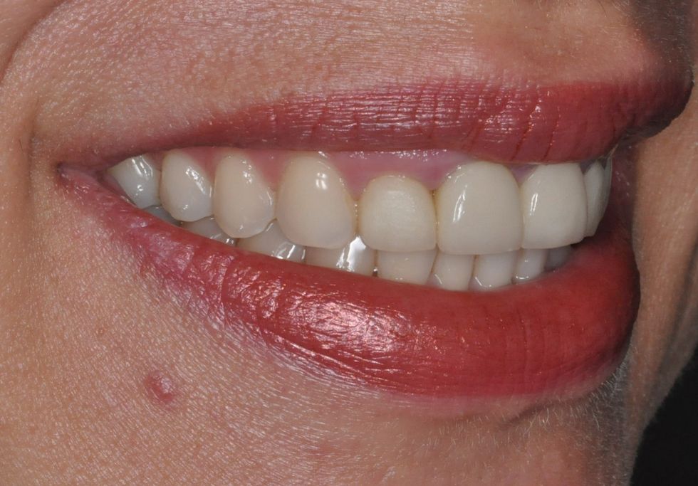 Before anterior cosmetic veneers with The Village Dental in Pinecrest FL-K2