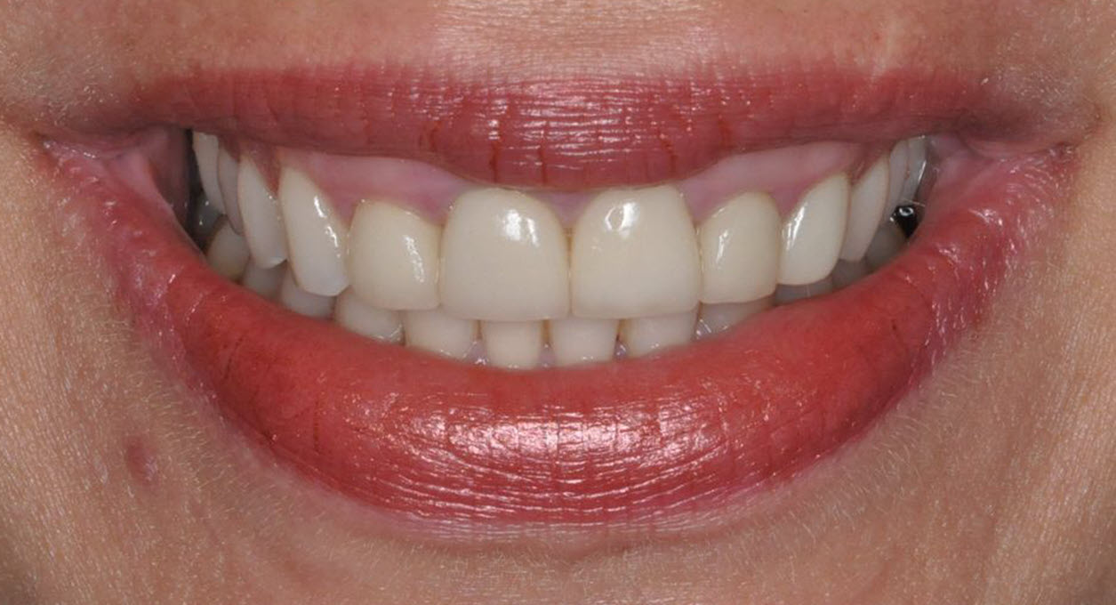 Before anterior cosmetic veneers with The Village Dental in Pinecrest FL-K