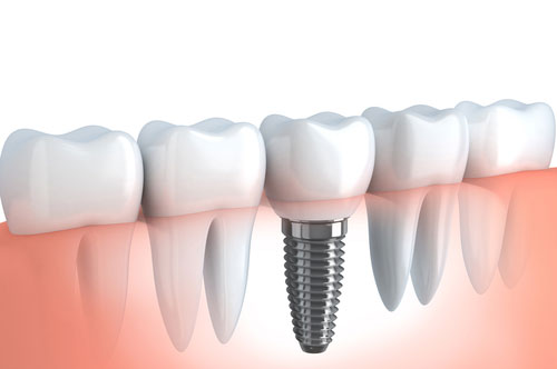 Dental implant illustration showcasing a titanium post surrounded by natural teeth, representing restorative dentistry services at The Village Dental in Pinecrest, FL.