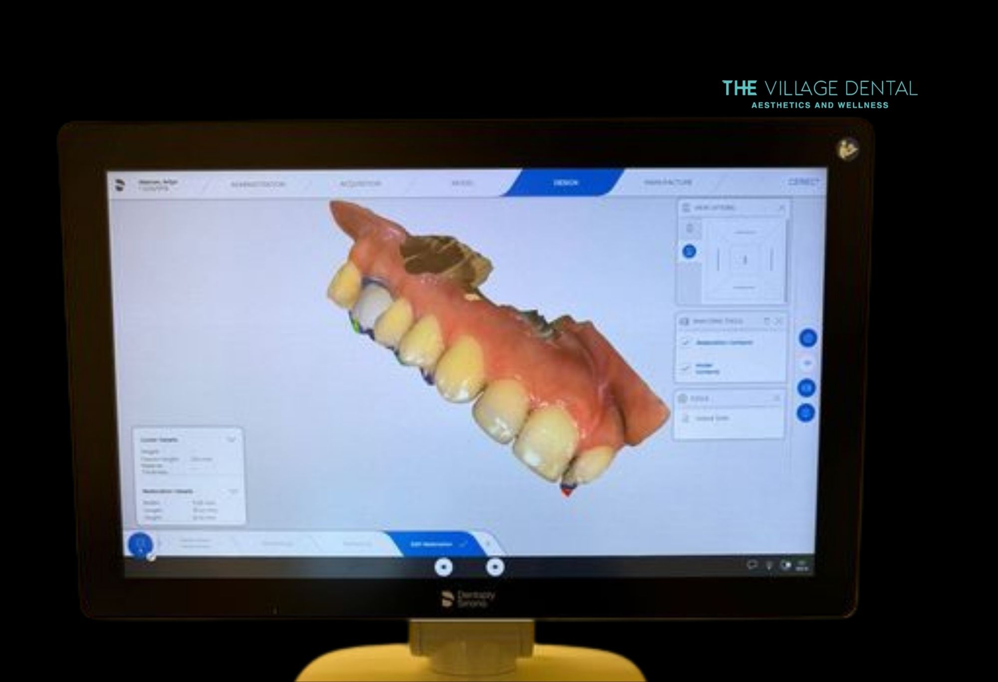 3D digital scan of a dental model displayed on a monitor, showcasing advanced iTero scanning technology for precise Invisalign treatment at The Village Dental in Miami, FL.