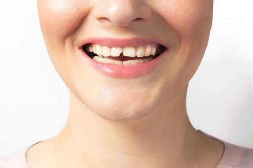 Smiling woman with chipped teeth, representing emergency dental care options at The Village Dental in Pinecrest, FL, focusing on restorative solutions like crowns and veneers.