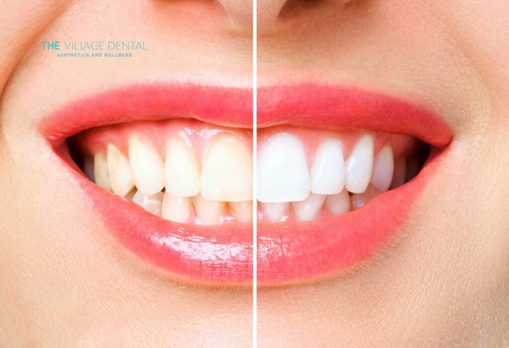 Before and after comparison of teeth whitening results, showcasing dramatic improvement in smile brightness at The Village Dental, Pinecrest, FL.