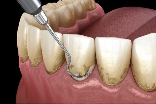 Illustration of dental scaling procedure targeting plaque and tartar buildup, highlighting the importance of deep cleanings for gum disease prevention at The Village Dental in Pinecrest, FL.