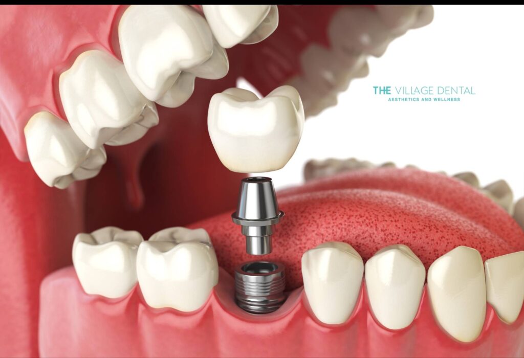 Implant-supported CEREC crown being placed on a dental implant, showcasing advanced restorative dentistry at The Village Dental in Pinecrest, FL.