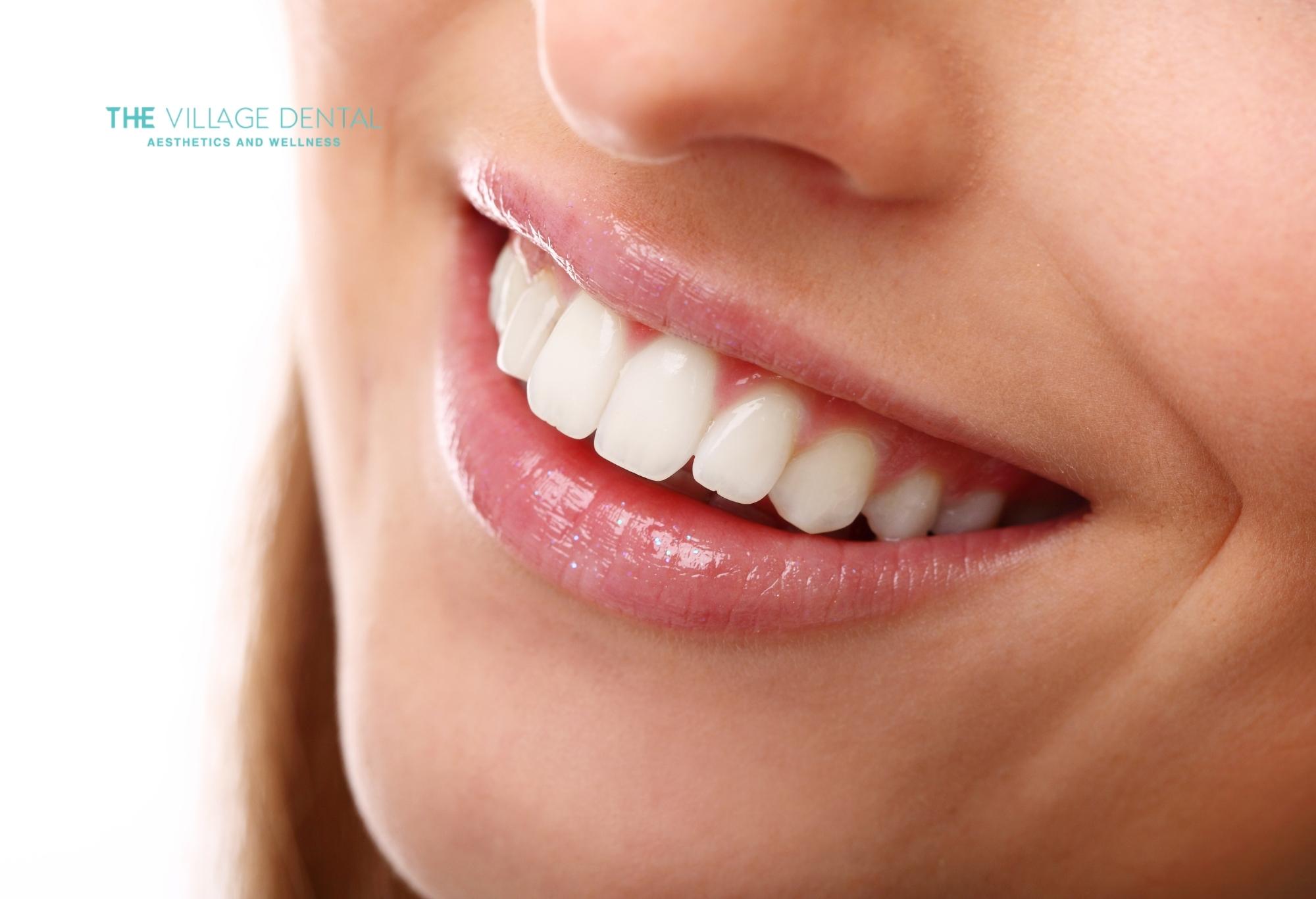 Close-up of a smiling woman showcasing bright, white teeth after professional teeth whitening at The Village Dental in Pinecrest, FL, emphasizing enhanced aesthetics and wellness.