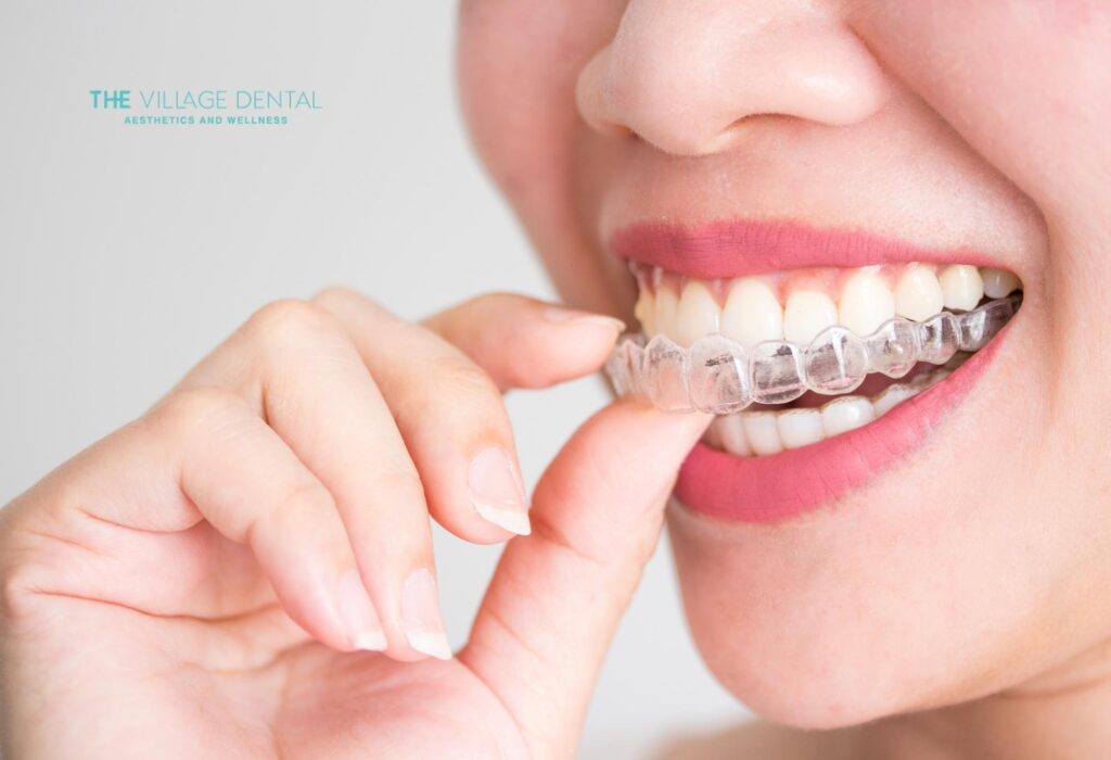 Invisible Braces Benefits : Woman inserting clear Invisalign aligner, showcasing discreet orthodontic treatment at The Village Dental in Pinecrest, FL, emphasizing comfort and aesthetics.