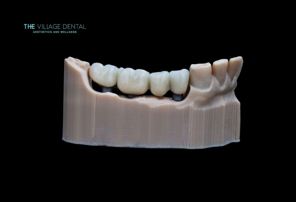 Multiple dental crowns on a model dental bridge demonstrating the All-on-4 implant technique at The Village Dental, providing a stable solution for patients in Pinecrest, FL, missing multiple teeth.