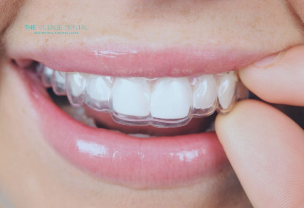 Close-up of a person inserting clear Invisalign aligners, showcasing the virtually invisible braces offered by The Village Dental in Pinecrest, FL, emphasizing comfort and discretion in orthodontic treatment.