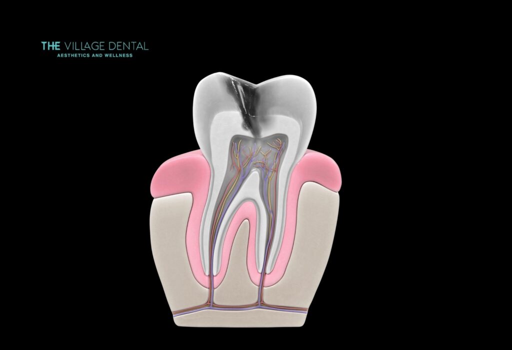 Diagram of a tooth illustrating root canal anatomy, including pulp, nerves, and surrounding structure, representing The Village Dental's focus on root canal treatments in Pinecrest, FL.