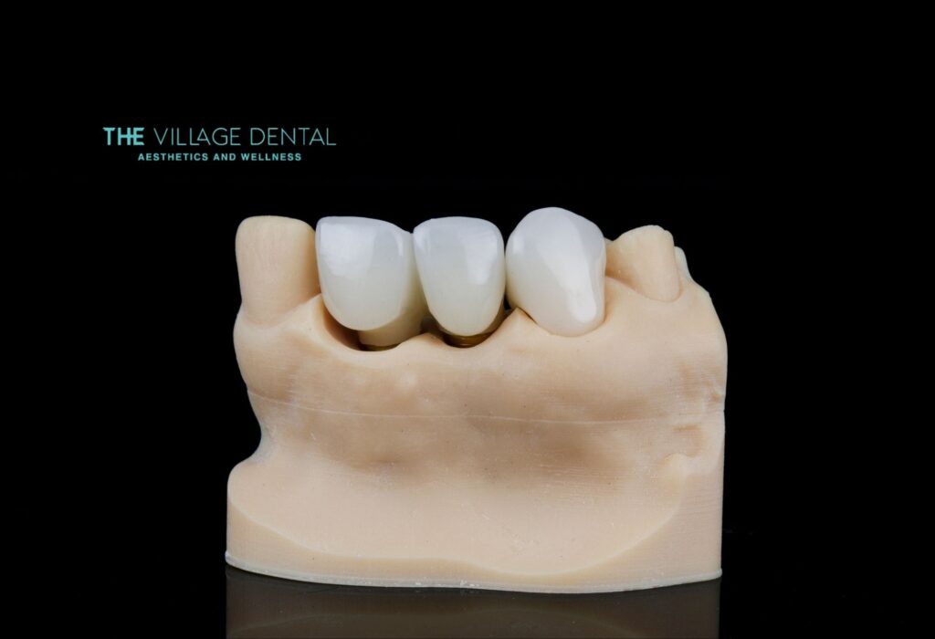 Custom dental bridge model featuring CEREC technology, showcasing same-day dental restoration services at The Village Dental in Pinecrest, FL, emphasizing aesthetics and wellness.