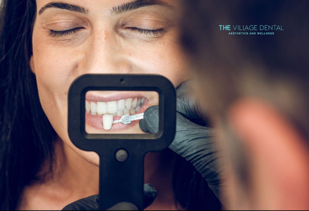 Close-up of a woman smiling while a dental professional uses a color guide to match shades for cosmetic dentistry at The Village Dental, focusing on personalized care in Pinecrest, FL.