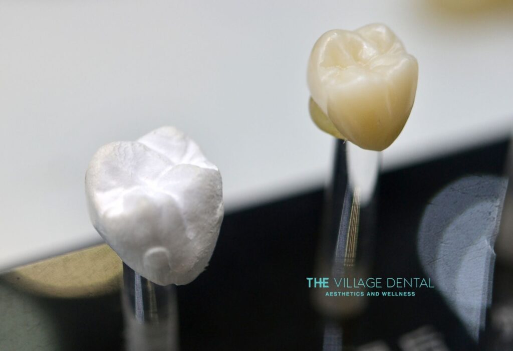 CEREC crowns displayed at The Village Dental, showcasing a white ceramic crown and a natural-colored crown, representing advanced same-day dental restoration options in Pinecrest, FL.